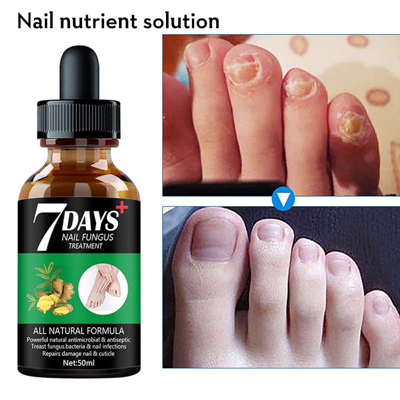 7DAYS Nail Fungus Treatment Serum Care Hand And Foot Care Removal