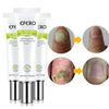 Nail Treatment Serum Nail Foot Nail Fungus Removal Gel Anti Infection Onychomycosis Nail Repair Cream Feet Care