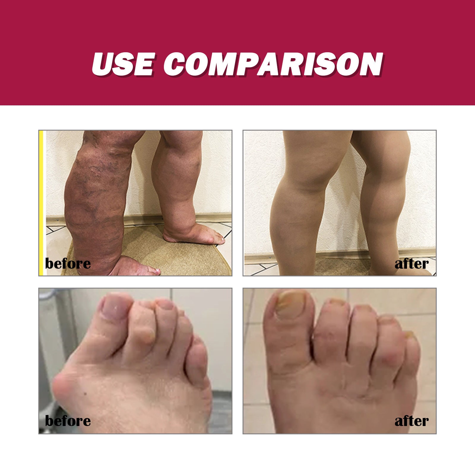 Protein Cream Soothes Joint Bone Soreness, Deformation, Correction And Repair